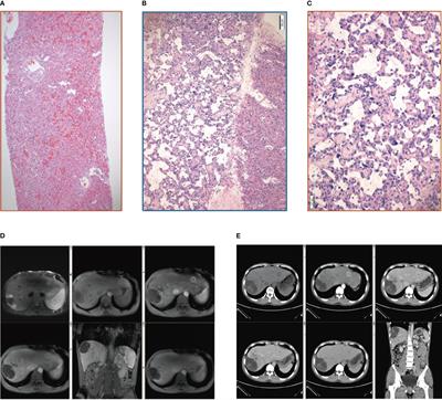 Primary hepatic angiosarcoma with noncirrhotic portal hypertension: A case report